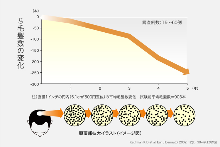 AGAは進行性の脱毛症状