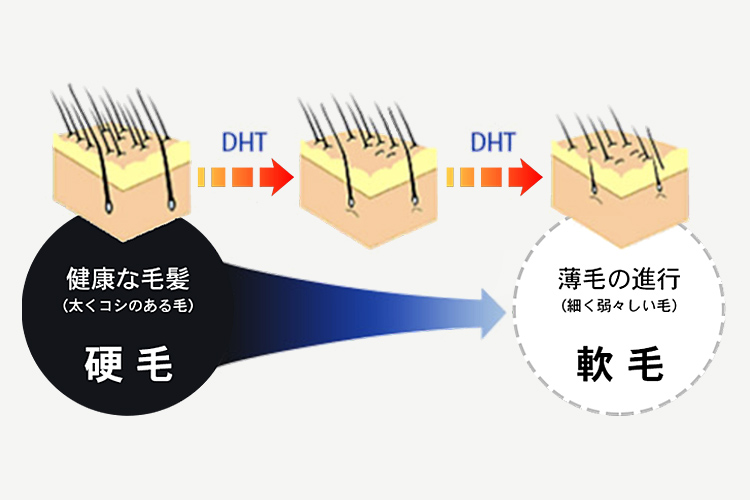 髪の軟毛化